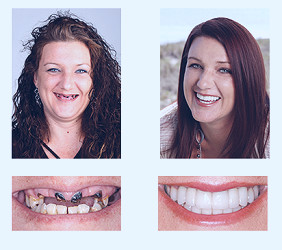 Dentures Orlando -Retained Dentures Treatment FL | Fine Dentistry